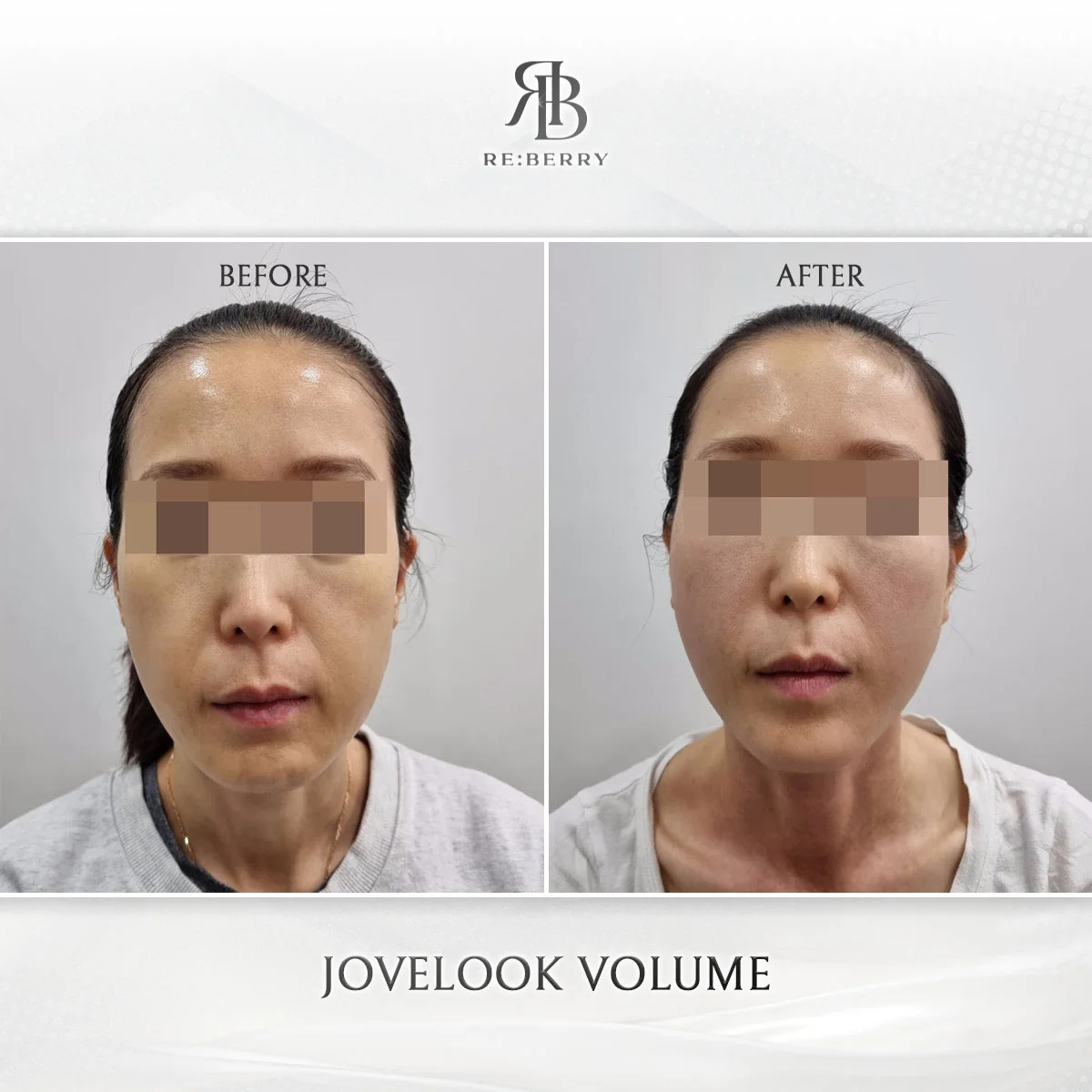 Volume filler before and after at RE:BERRY Myeongdong